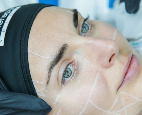 Ultrasuoni microfocalizzati ecoguidati per la pelle del viso cadente