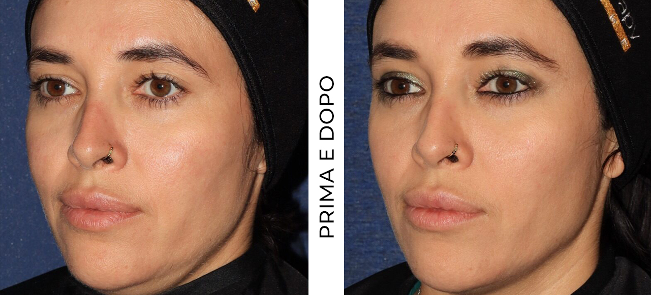 Attuale paziente Ultherapy®. I risultati variano da persona a persona.